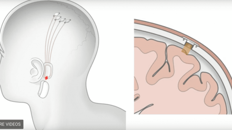 Elon Musk desarrolla chip para incrustar en el cerebro y ‘tratar’ autismo o esquizofrenia