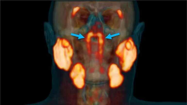 Descubren accidentalmente un nuevo y misterioso órgano de la cabeza