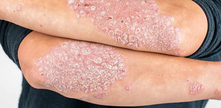 Psoriasis: la solución está en el sistema inmunitario